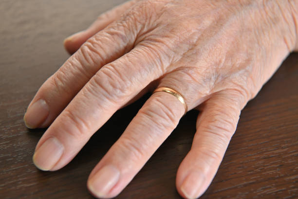 A senior woman's wrinkled finger wearing a wedding ring
