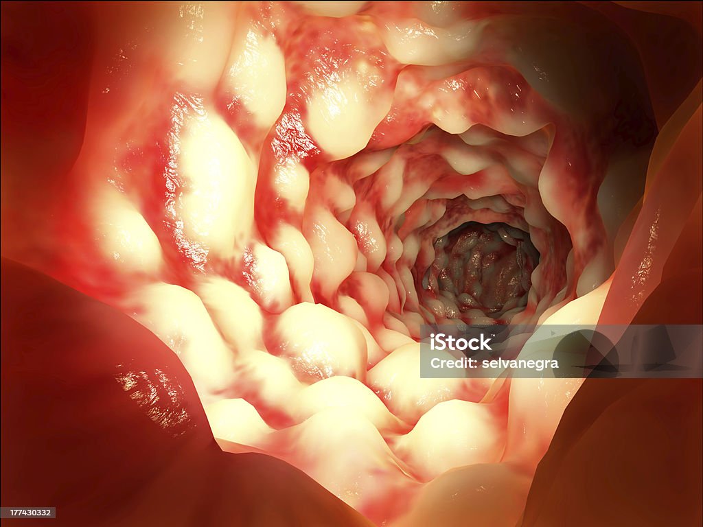 Morbus Crohn disease Intestine affected by the Morbus Crohn disease Colonoscopy Stock Photo