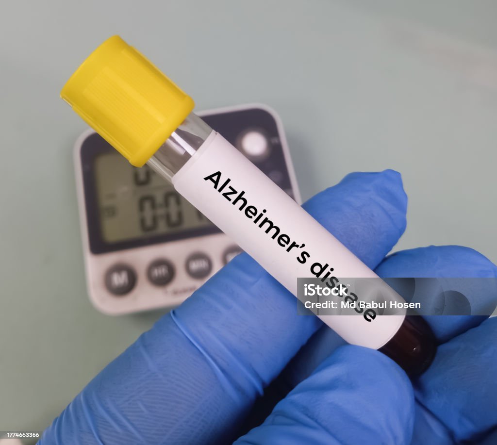 Blood Sample For Atn Profile Test To Diagnosis Of Alzheimers Disease Blood Sample For Atn Profile Test To Diagnosis Of Alzheimers Disease