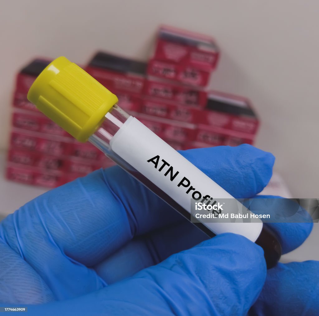Blood Sample For Atn Profile Test To Diagnosis Of Alzheimers Disease Blood Sample For Atn Profile Test To Diagnosis Of Alzheimers Disease