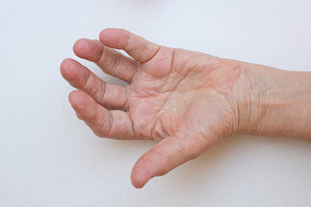 istock Closeup of hand with arthritis 177517017