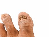 toes with onychomycosis with white background. isolated
