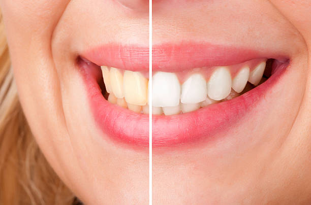 istock Dental Whitening 177521246
