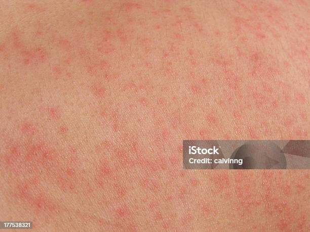 Foto de Dermatite Alérgica Da Pele e mais fotos de stock de Alergia - Alergia, Alimento com mordida, Antialérgico