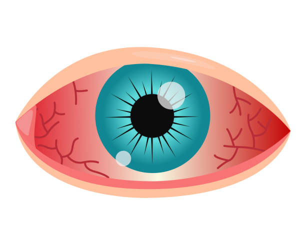 Eye Sweilling Animation 110+ Red Swollen Eyes Stock Illustrations, Royalty-Free Vector Graphics ...