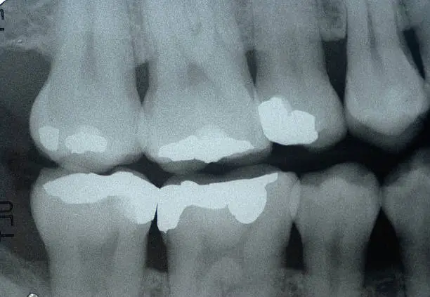 Dental x- ray ( Bitewing technic ) for check dental caries