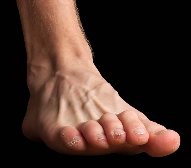 Foot with broken skin on toes stock photo