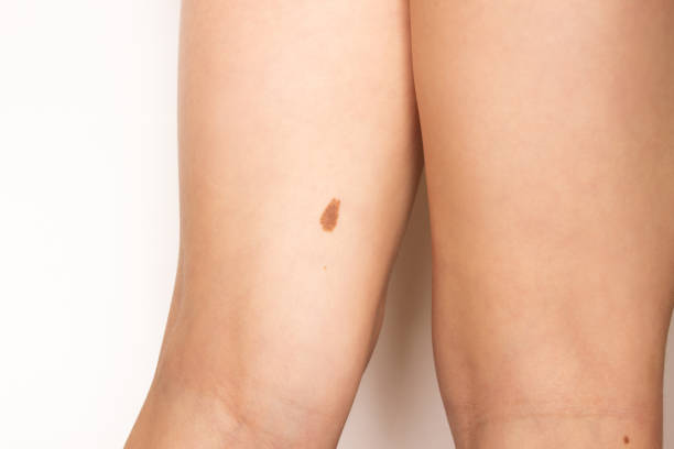 A large mole or birthmark on a child's leg A large mole or birthmark on a child's leg. An irregularly shaped dark brown spot on the skin. Nevus close-up. Medicine and health, dermatology brown leg stock pictures, royalty-free photos & images