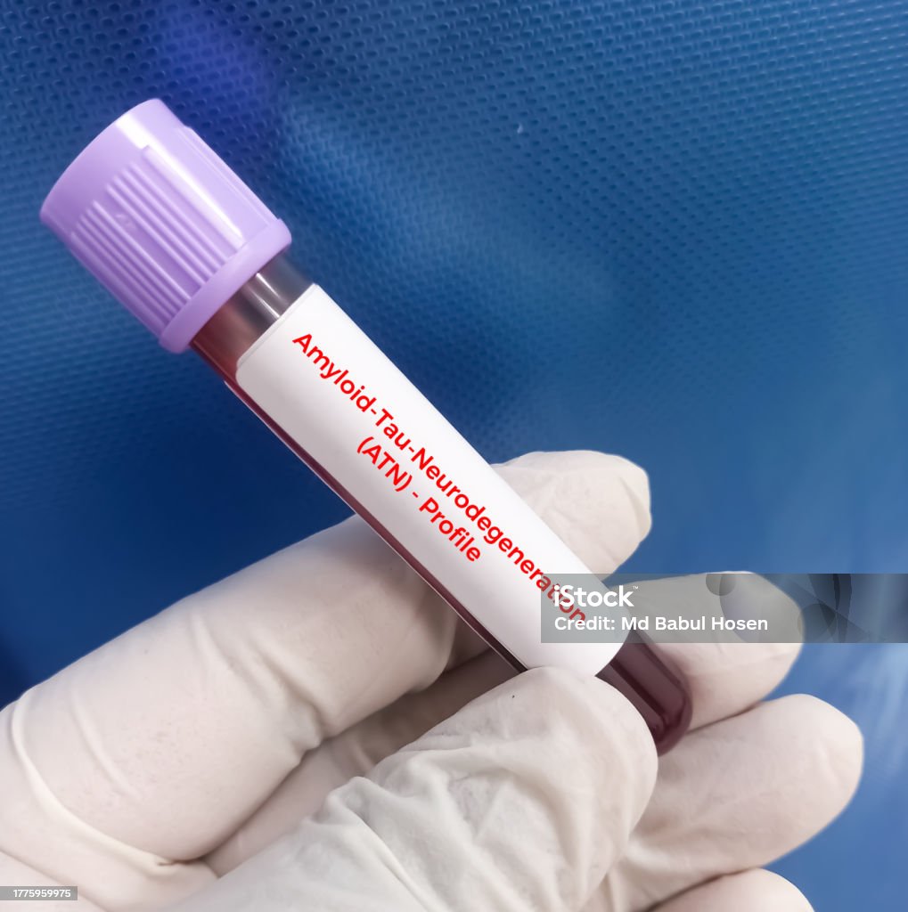Blood Sample For Atn Profile Test To Diagnosis Of Alzheimers Disease Blood Sample For Atn Profile Test To Diagnosis Of Alzheimers Disease
