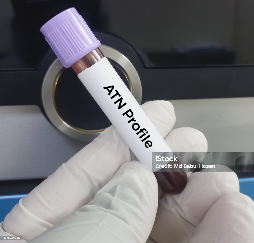 Blood Sample For Atn Profile Test To Diagnosis Of Alzheimers Disease Blood Sample For Atn Profile Test To Diagnosis Of Alzheimers Disease
