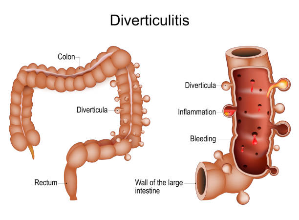 Colonic Diverticulitis. vector art illustration