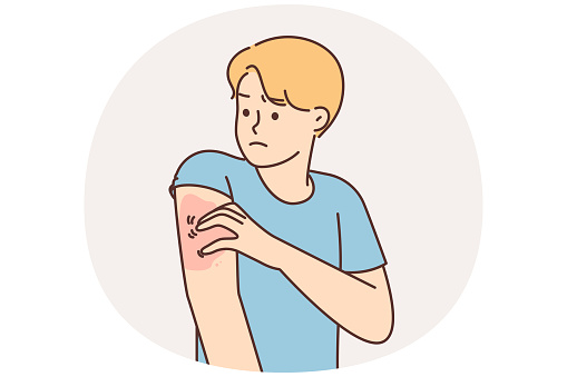 Unhealthy man scratching arm suffer from monkey pox. Unwell guy itch hand struggle with dermatology problem. Healthcare. Vector illustration.