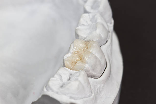 A cast model of a person's teeth closeup for dental onlay on a molar tooth shown on a plaster model inlay stock pictures, royalty-free photos & images