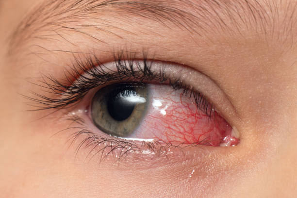closeup irrité les yeux injectés de sang rouges infectés, conjonctivite - conjunctivitis sore eyes child human eye photos et images de collection