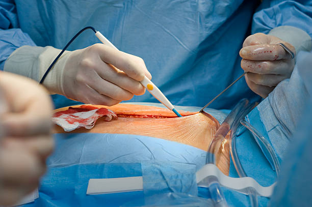 ディスポーザブル electrosurgical ペンシル - gauze scalpel surgeon healthcare and medicine ストックフォトと画像
