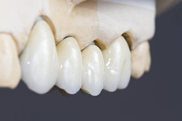 dental keramik-brücke - cast in stone stock-fotos und bilder