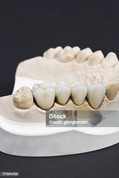歯科セラミックブリッジ - クローズアップのストックフォトや画像を多数ご用意 - クローズアップ, テクノロジー, ヒトの歯