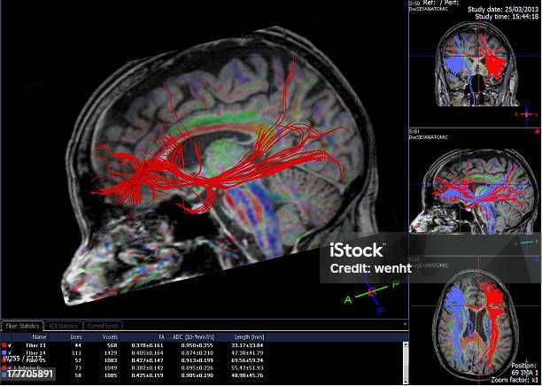 コンピュータで生成された画像の Tractography の脳 - 3Dのストックフォトや画像を多数ご用意 - 3D, 3Dスキャン, MRI検査