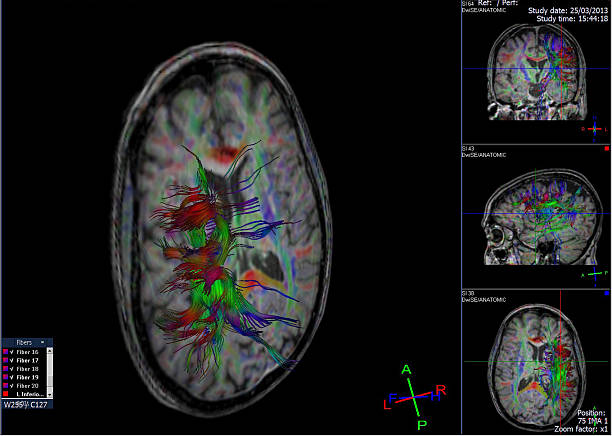 tractografía (dti- imágenes con tensor de difusión de mri) de cerebro - mri scan human nervous system brain medical scan fotografías e imágenes de stock