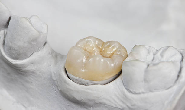 dental onlay auf einer besetzung modell - keramik fotos stock-fotos und bilder
