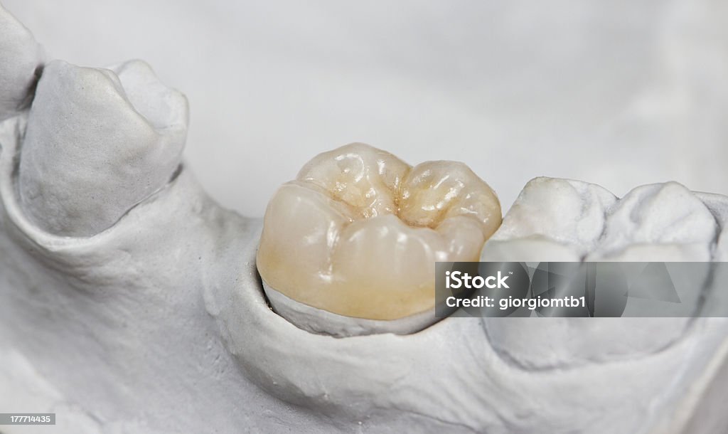 dental onlay on a cast model closeup for dental onlay on a molar tooth shown on a gypsum model Tooth Crown Stock Photo