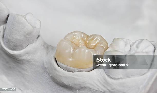 Dental Onlay On A Cast Model Stock Photo - Download Image Now - Tooth Crown, Ceramics, Dental Equipment