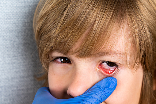 a child with red purulent eyes from conjunctivitis, childhood eye disease, allergies in a child and tearing.