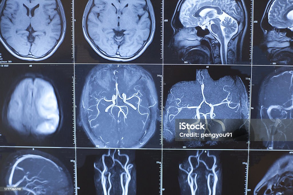 Ludzki mózg perspektywy zdjęcia rentgenowskie - Zbiór zdjęć royalty-free (Anatomia człowieka)