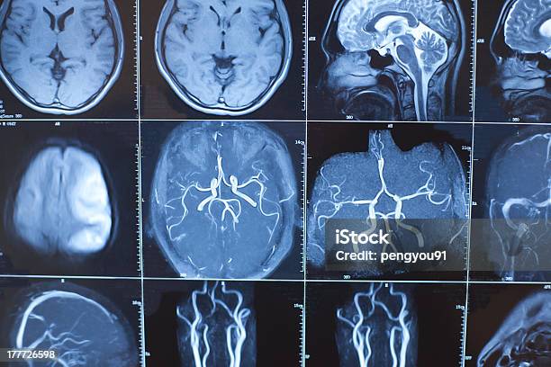 Foto de Cérebro Humano Foto De Raiox Perspectiva e mais fotos de stock de Anatomia - Anatomia, Computação Gráfica, Cérebro humano
