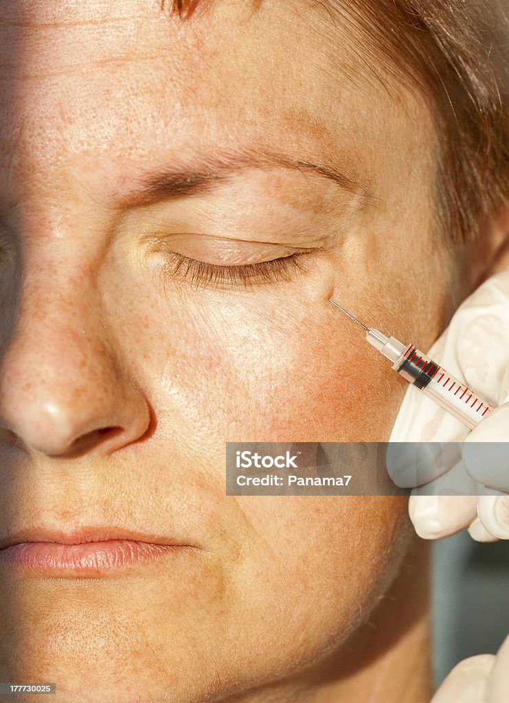 Inyección de Botox - Foto de stock de Adulto libre de derechos