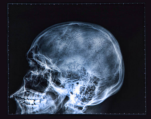 istock X-ray of human Head 177731147