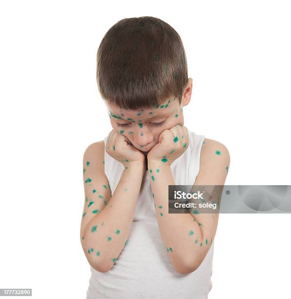 汚物 Child水疱瘡 - 1人のストックフォトや画像を多数ご用意 - 1人, にきび, カットアウト