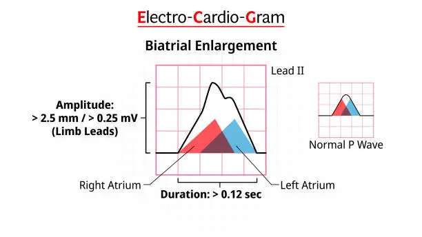 Vector illustration of P Wave - ECG Biatrial Enlargement/Hypertrophy - Morphology P Wave