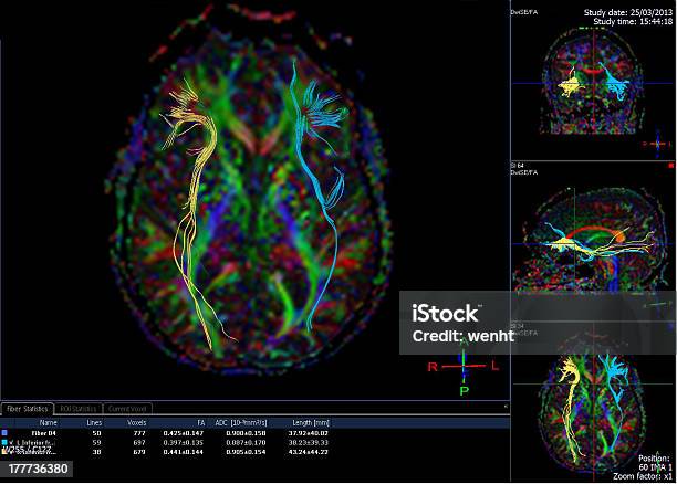 Tractografía De Cerebro Foto de stock y más banco de imágenes de Cerebro