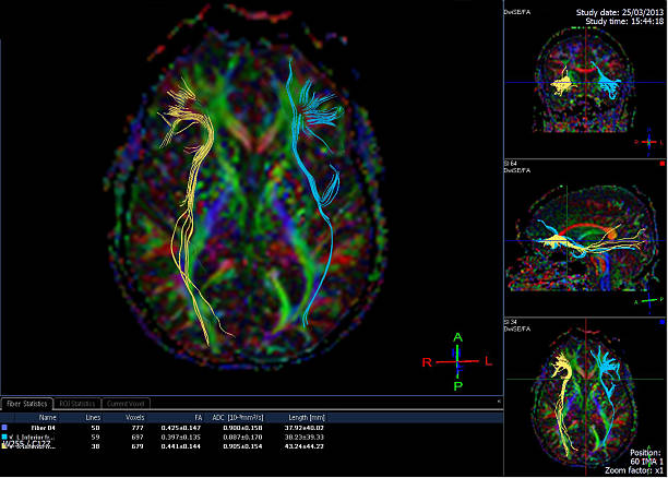 dti- tractography (diffusion tensor imaging mri del cervello) - mri scan human nervous system brain medical scan foto e immagini stock