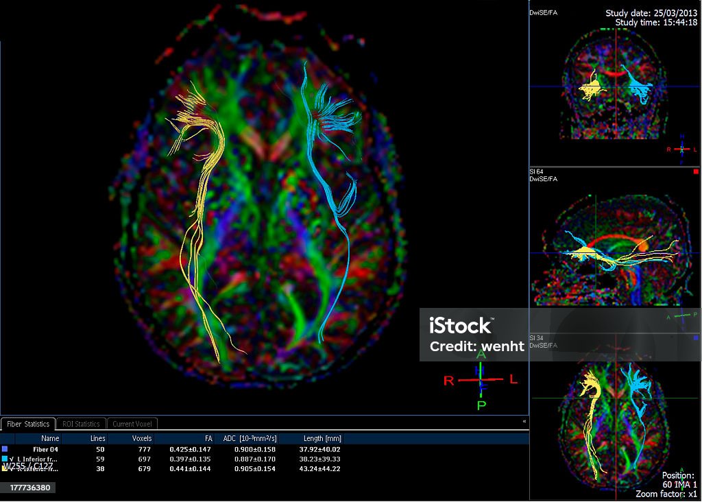 Tractography (DTI- 확산 텐서 영상 뇌 MRI - 로열티 프리 뇌 스톡 사진