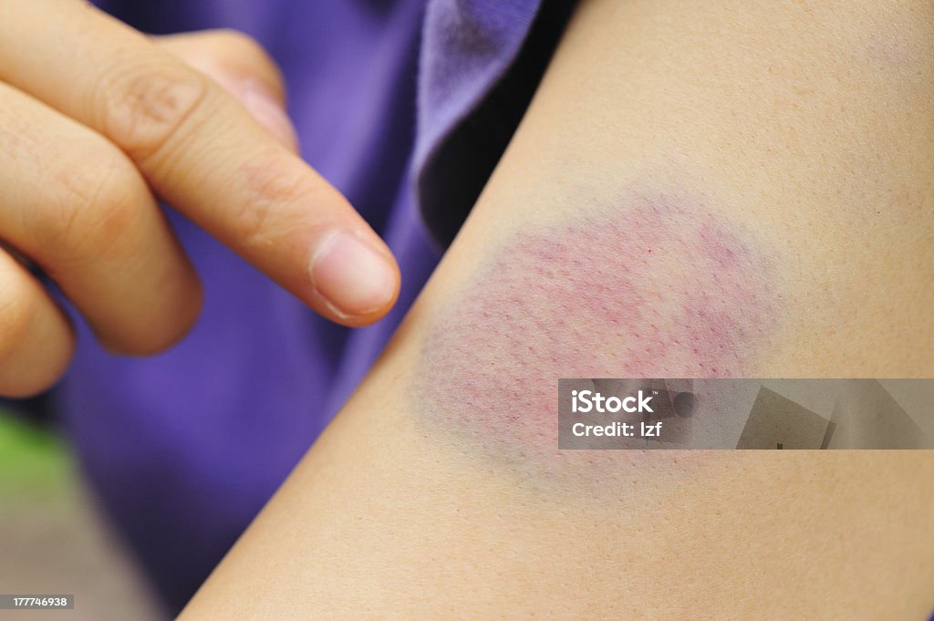 A finger pointing to a bad bruise on the arm - Royalty-free Blauwe plek Stockfoto