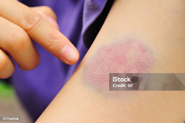 A Finger Pointing To A Bad Bruise On The Arm Stockfoto en meer beelden van Blauwe plek - Blauwe plek, Kindermishandeling, Wond