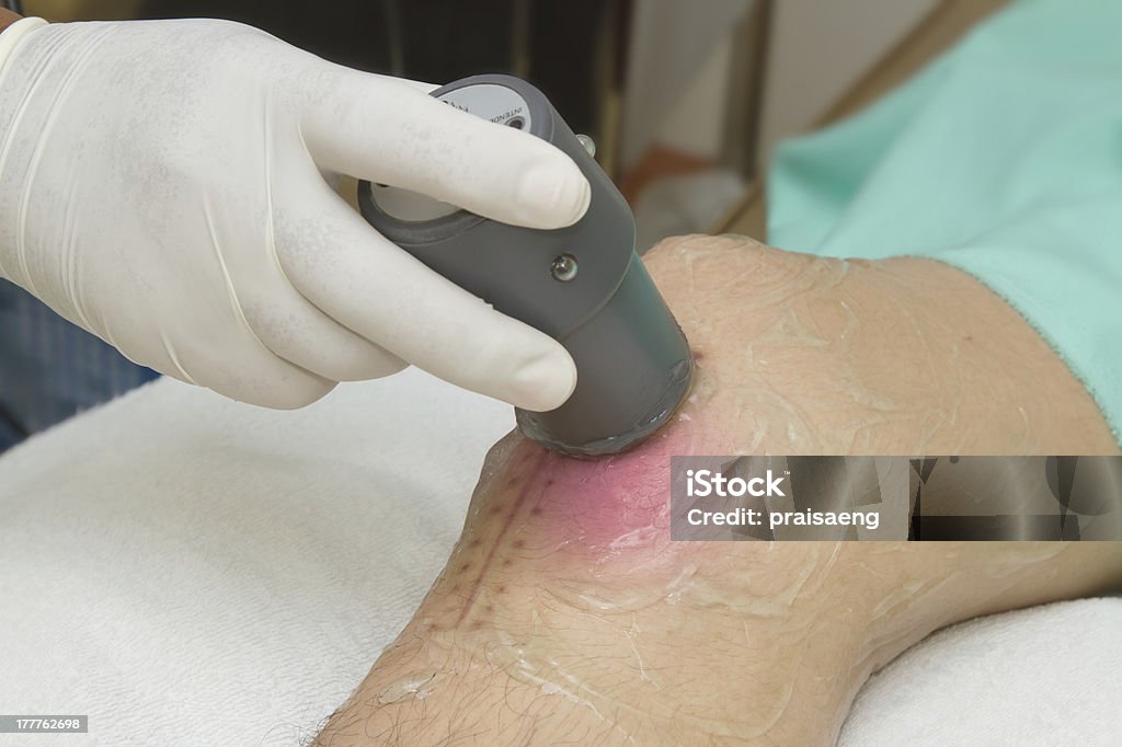 Physiotherapist is applying ultrasound therapy on the knee joint Physiotherapist is applying ultrasound therapy on the knee joint with ultrasound head transducer. Medical equipment use for release pain Ultrasound Stock Photo