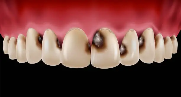 Vector illustration of Tooth decay and calculus on teeth