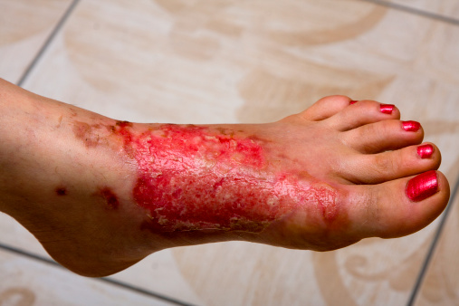 Severe burns in the women's leg .