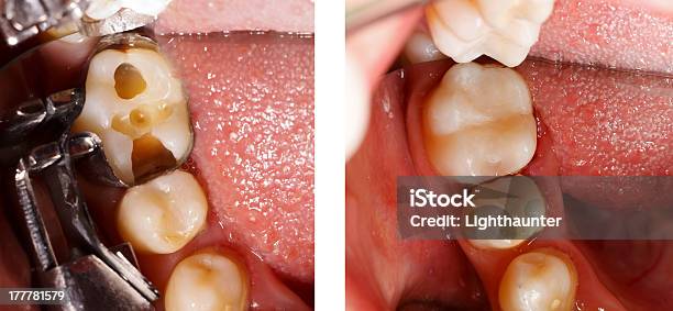 Wypełnienie Zęba Przez Dentystę - zdjęcia stockowe i więcej obrazów Plomba - Plomba, Odnawiać, Zdrowie jamy ustnej