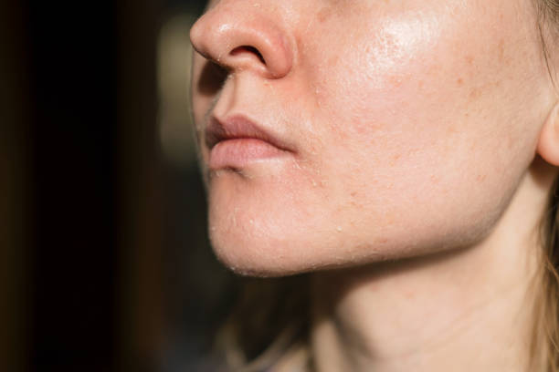 skóra kobiety łuszczy się na ustach. sucha skóra. podrażnienie skóry twarzy po peelingu, po zimnej, wietrznej pogodzie. ciemne tło, widok według profilu - human skin dry human face peeling zdjęcia i obrazy z banku zdjęć