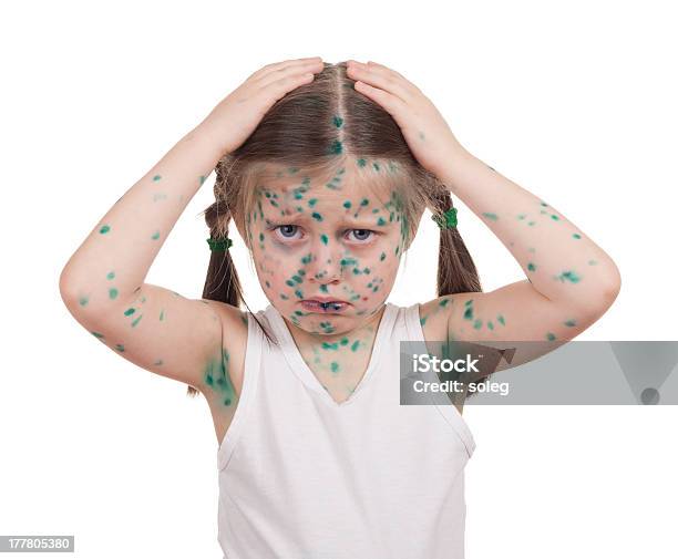 Enjoado Child Varicela - Fotografias de stock e mais imagens de Acne - Acne, Bodysuit, Branco