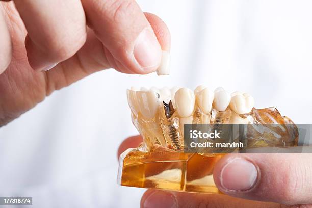 Arzt Mit Dental Audiosystem Stockfoto und mehr Bilder von Zahnimplantat - Zahnimplantat, Zahnarztausrüstung, Zahnpflege