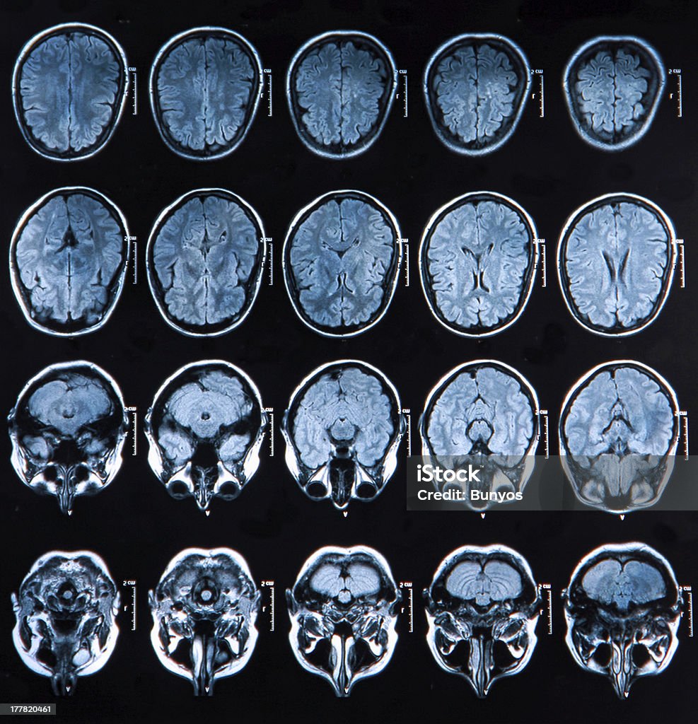 Mri cérebro Scan - Foto de stock de Doença de Alzheimer royalty-free