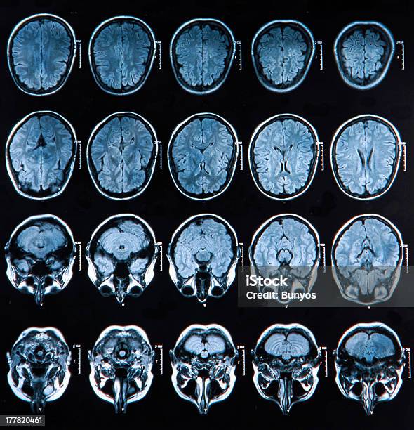 Foto de Mri Cérebro Scan e mais fotos de stock de Doença de Alzheimer - Doença de Alzheimer, Anatomia, Cabeça Humana