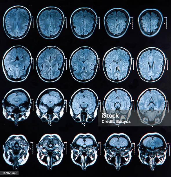 Мртсканирование Головного Мозга — стоковые фотографии и другие картинки Болезнь Альцгеймера - Болезнь Альцгеймера, Machinery, Анатомия