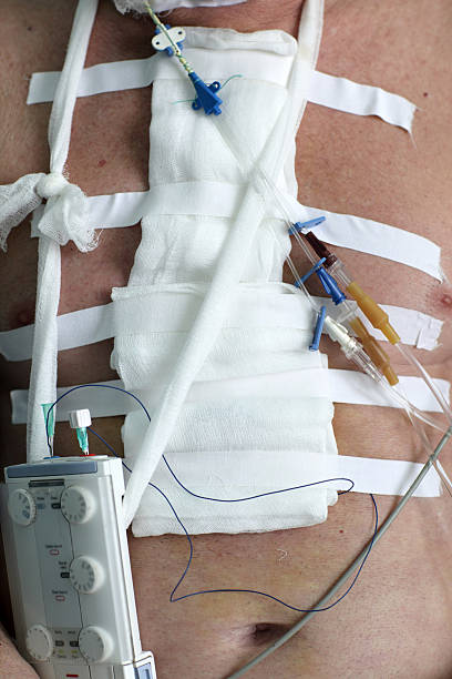 фиксаторы на груди - pacemaker torso chest male стоковые фото и изображения