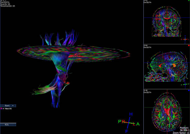 tractography (dti- 확산 텐서 영상 뇌 mri - brain surgery healthcare and medicine brain surgery 뉴스 사진 이미지